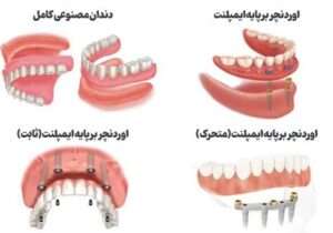 خداحافظی با لقی دندان مصنوعی؛ راهنمای جامع اوردنچر با ایمپلنت برای سالمندان