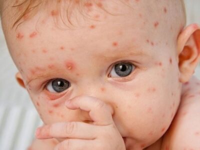 شیوع «آبله مرغان» در بهار